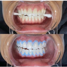 Teeth whitening 