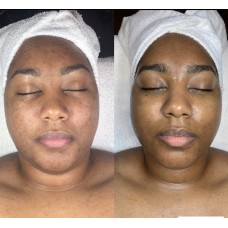 Anti-aging facials 