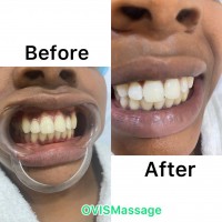 Teeth whitening (platinum package)