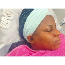 High frequency facial 