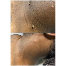 Skin tag removal 