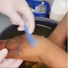 Dark knuckles removal 