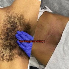 Brazilian waxing 